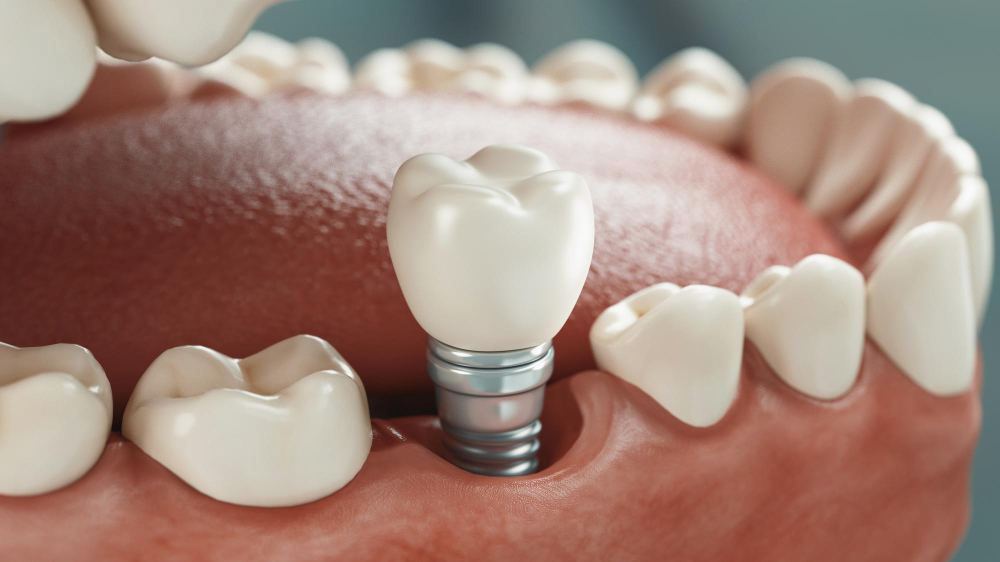 Dental Implants  Green Valley, AZ